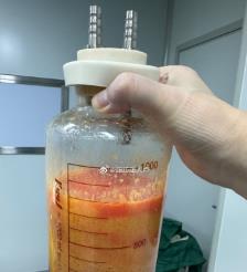 黄南水动力吸脂手术要做多久？